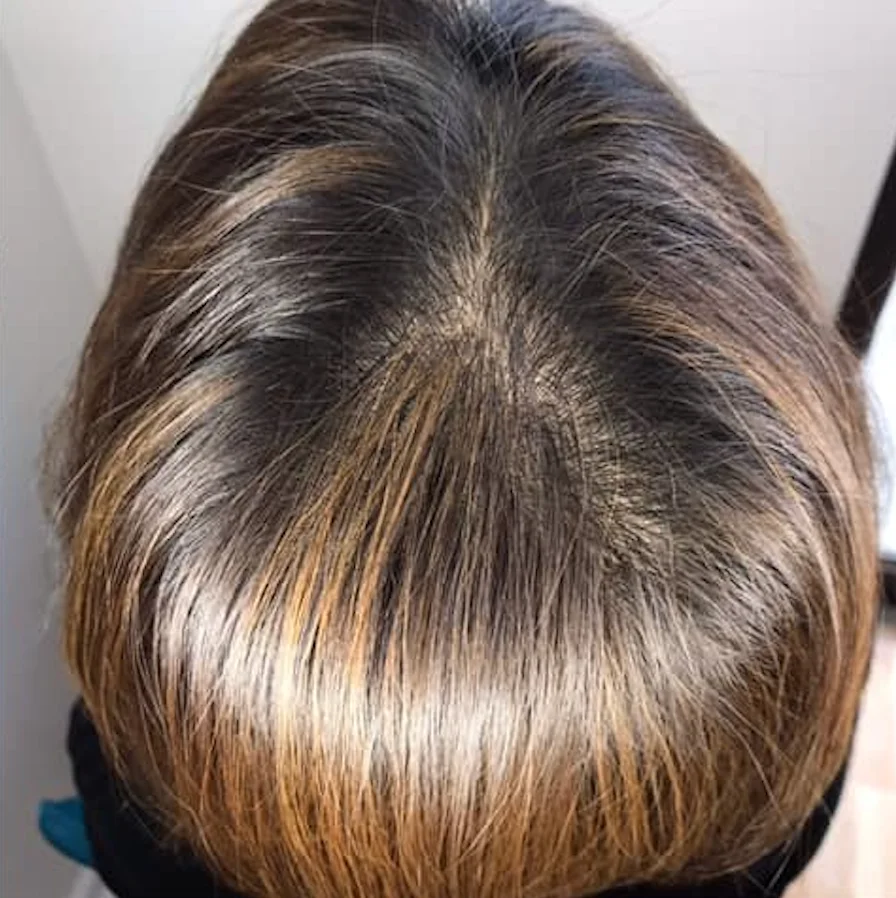 Thinning crown · Women — after