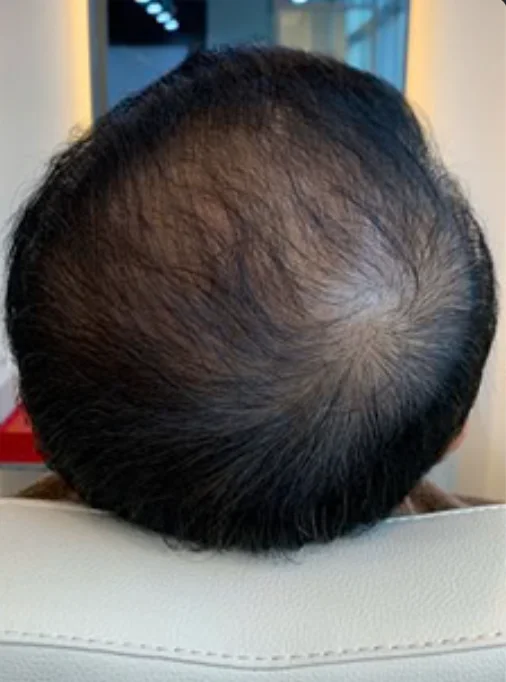 Crown hair loss · Men — after