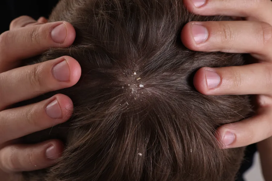 Flakes on a scalp