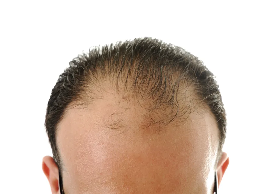 Receding, thinning hairline